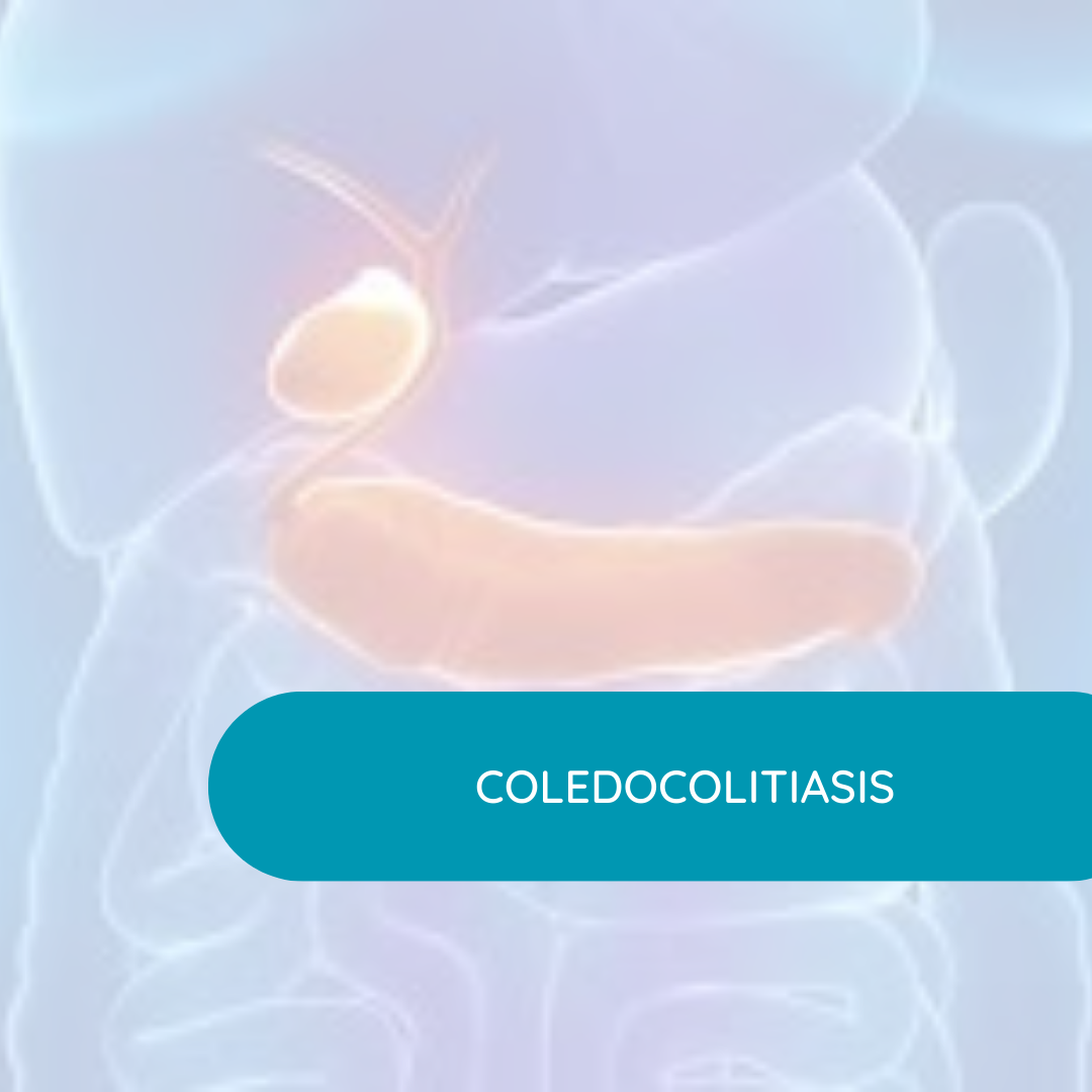 coledocolitiasis